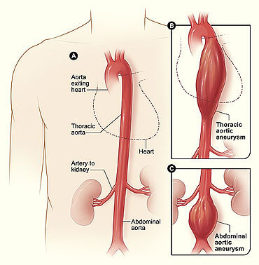 aortic-aneurysm