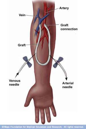 dialysis av graft