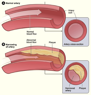 claudication