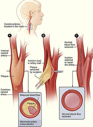 carotid endarterectomy