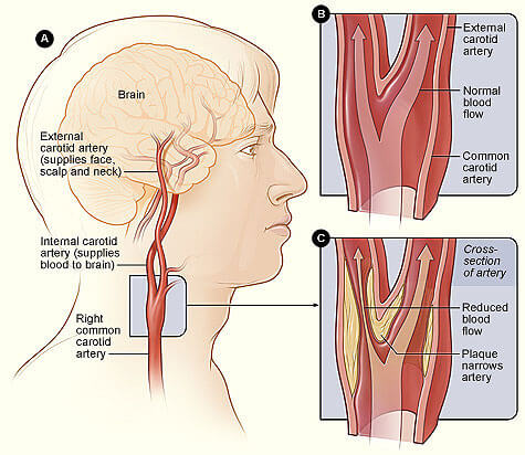 carotid narrowing