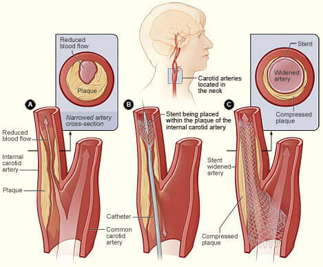 stent carotídeo