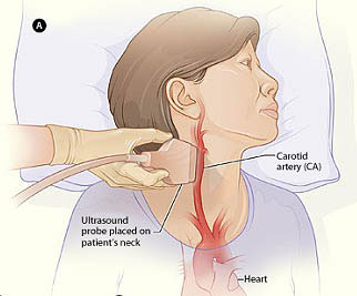 carotid ultrasound