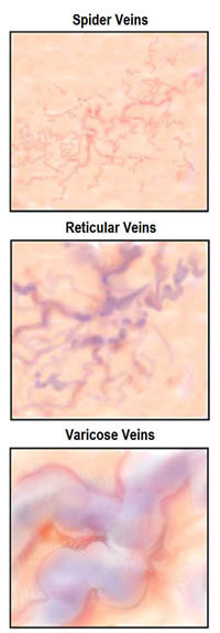 comparación de venas reticulares con otras venas enfermas