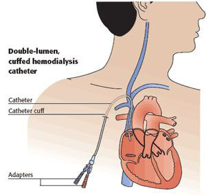 dialysis catheter