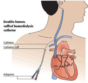 catéter de diálisis