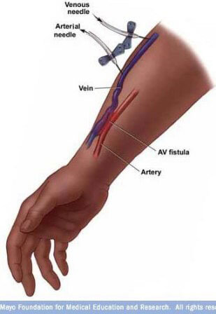 Dialysis access av fistula