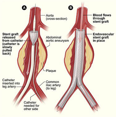 stent aórtico endovascular