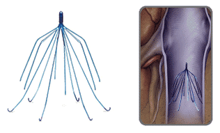 ivc filter for treatment of deep vein thrombosis