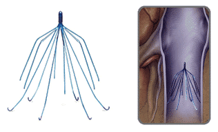 filtro de vena cava para el tratamiento de la trombosis venosa profunda