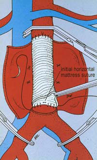 Open Surgery for Aortic Aneurysm