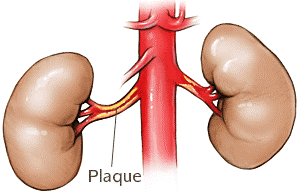 renal_artery_stenosis