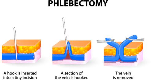 stab phlebectomy procedur för borttagning av ven