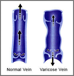 Varicose vein treatment - valves