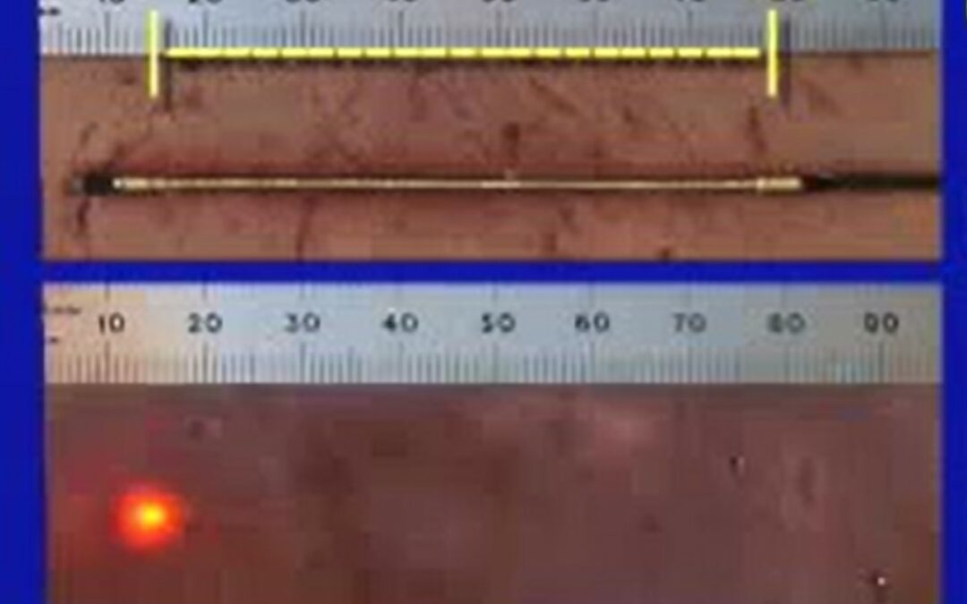 Terapia con láser endovenoso versus ablación por radiofrecuencia (EVLT o EVLA vs RFA)