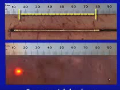 Endovenous Laser Therapy vs Radiofrequency Ablation (EVLT or EVLA vs RFA)