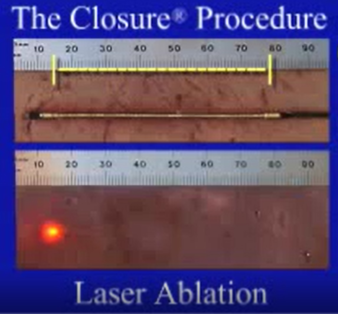 Radiofrequency ablation (RFA) Endovenous laser therapy (EVLT)