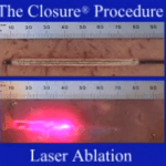 Endovenous Laser Therapy vs Radiofrequency Ablation (EVLT or EVLA vs RFA)