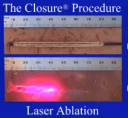 Endovenous Laser Therapy vs Radiofrequency Ablation (EVLT or EVLA vs RFA)