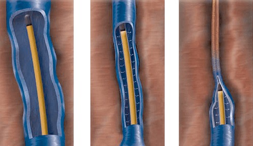 closurefast radiofrequency ablation rfa