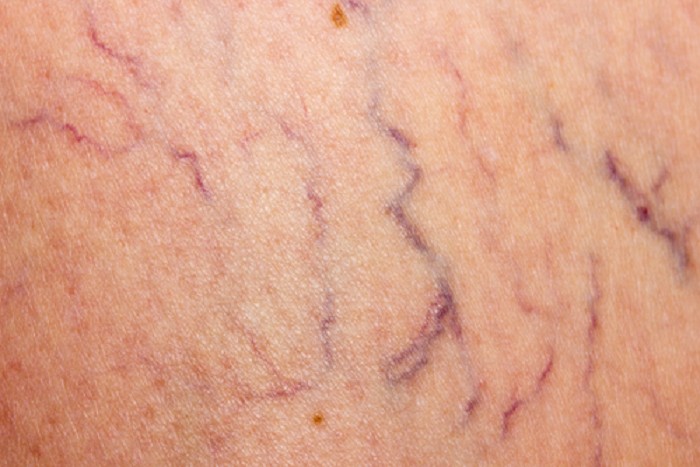 aluminio expedición marido Eliminación de la vena de la araña ( Spider Vein Removal ) | Venas arañas | Venas varicosas | Enfermedad de las venas aluminio expedición marido Eliminación de la vena de la araña ( Spider Vein Removal ) | Venas arañas | Venas varicosas | Enfermedad de las venas